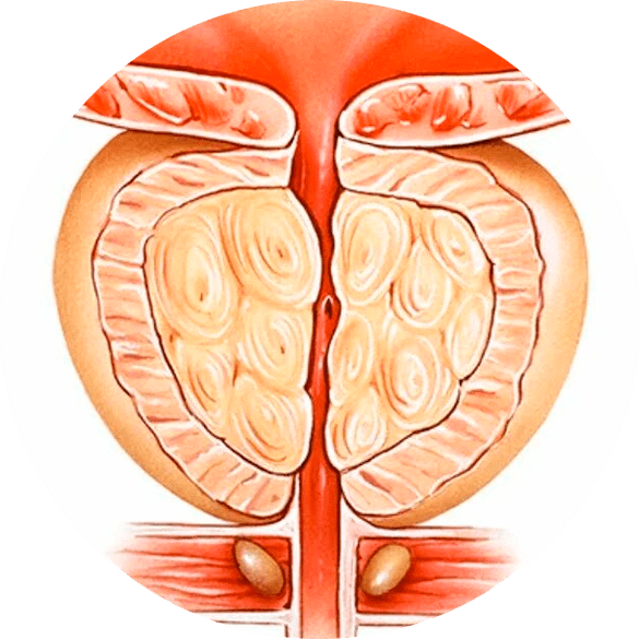 Consequências da prostatite não tratada
