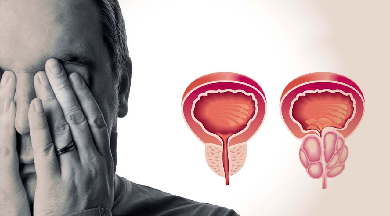 prostatite crônica em homens