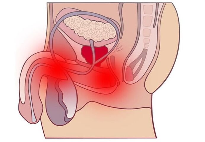 métodos de tratamento de prostatite