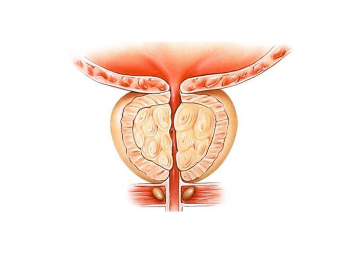 tratamento da prostatite com remédios populares